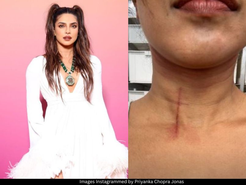 Priyanka Chopra injury 