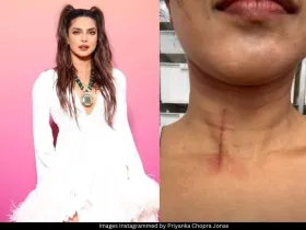 Priyanka Chopra injury 